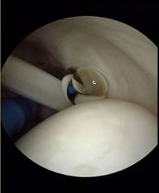 Schultergelenksspiegelung (Arthroskopie): intakter Sehnenansatz